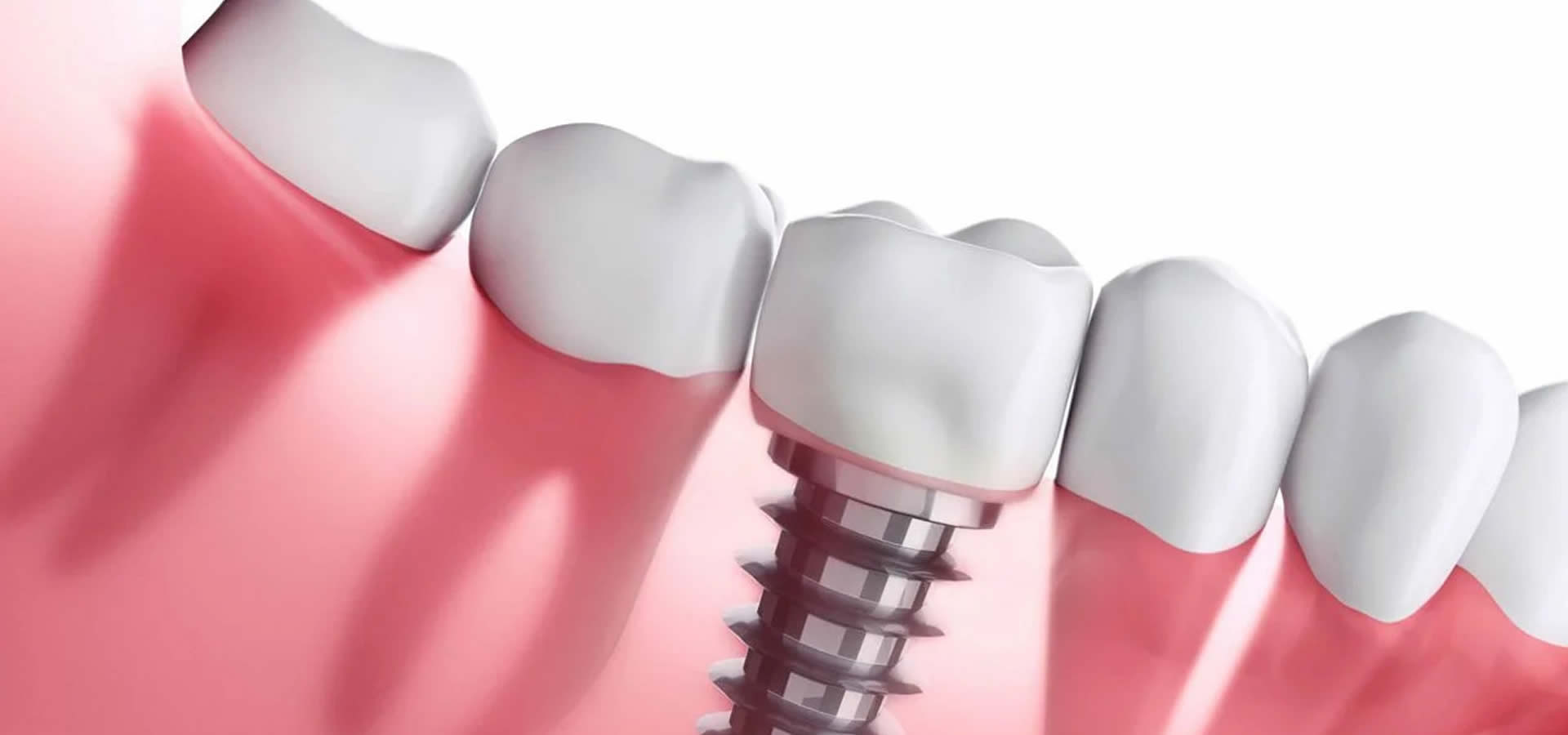 Συχνές Ερωτήσεις & Πρακτικές Συμβουλές για Οδοντικά Εμφυτεύματα