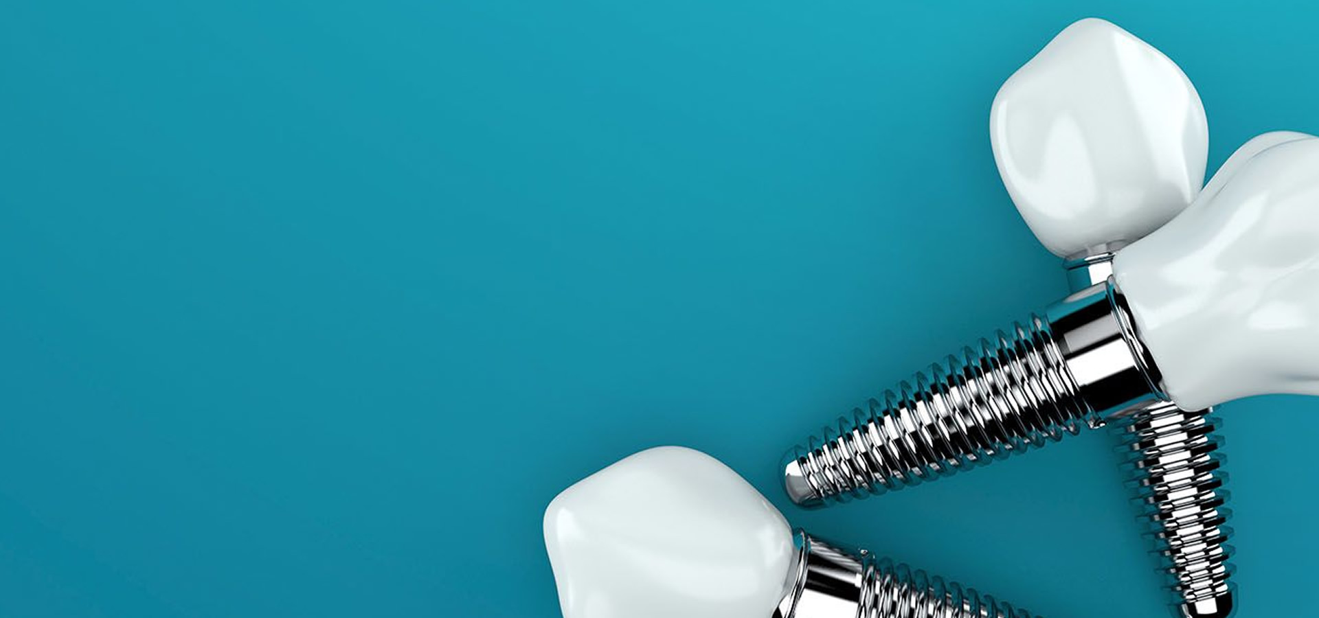 Οδοντικά Εμφυτεύματα: Μύθοι & Πραγματικότητα και ένας σύντομος οδηγός για τα εμφυτεύματα